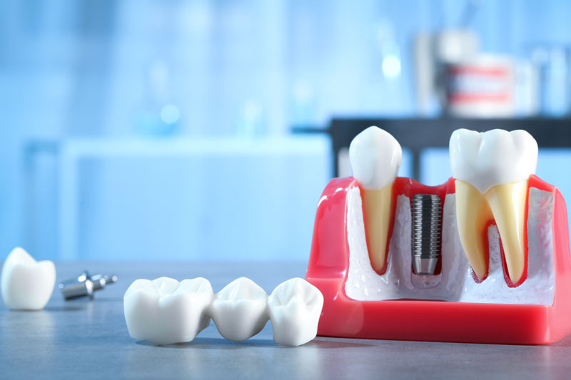 The image features a dental model with teeth, including dental implants in the jaw section, alongside extracted teeth. It is likely used for educational purposes in dental clinic or schools.