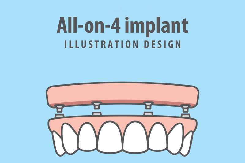 cute dental model illustration of an all on 4 full arch implant