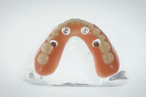 a full arch of teeth with 4 holes for implants to be placed in