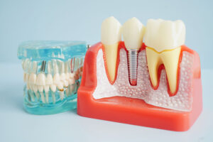 a cutaway of the jaw showing a dental implant beside teeth and a full set of teeth next to it