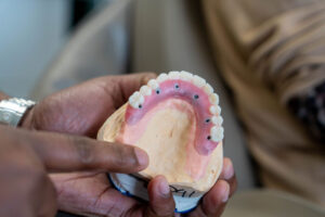 a full arch of teeth with 6 holes for implants to be placed through