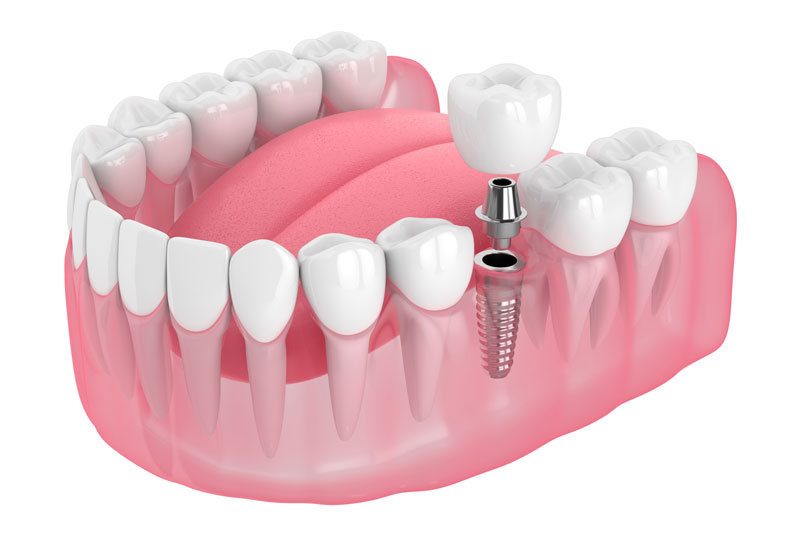 Dispelling Myths about Tooth Implants in Phoenix, AZ: Your Comprehensive Guide
