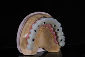 all on x dental implants with a full set of teeth going across the implants