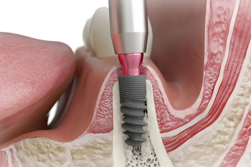 All on 4 Dental Implants: Revolutionizing Smiles in Phoenix, AZ