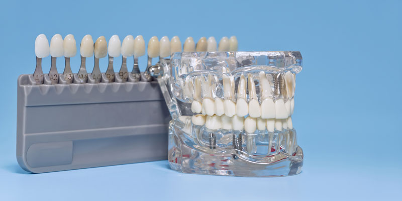 Understanding Your Abutment on Implant: A Comprehensive Guide to Dental Implants Success
