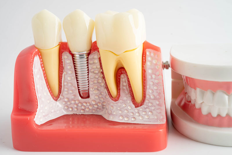 a single dental implant and a full arch of teeth next to it
