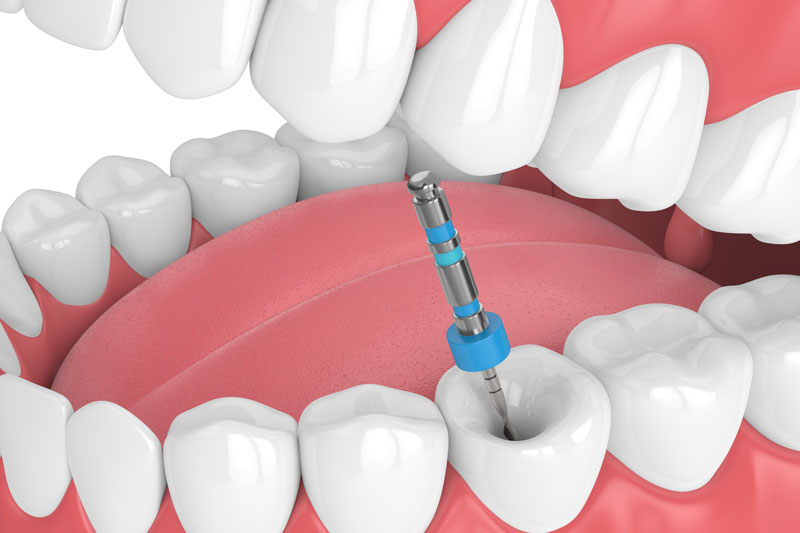 a person getting a filling and scraping out the cavity