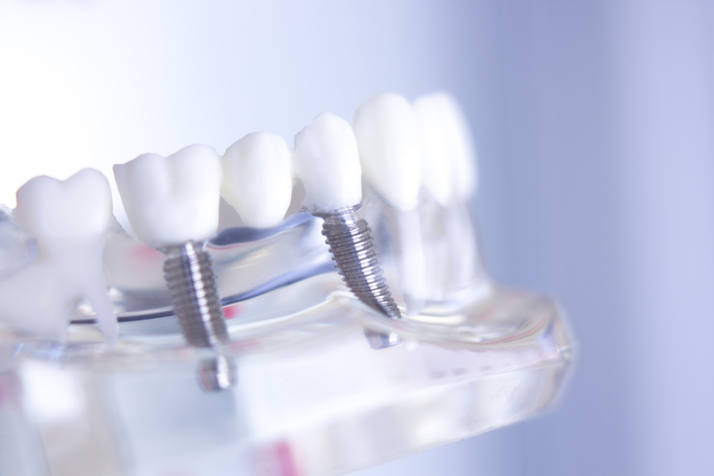 Understanding All-On-4 Clinics: Benefits and Considerations