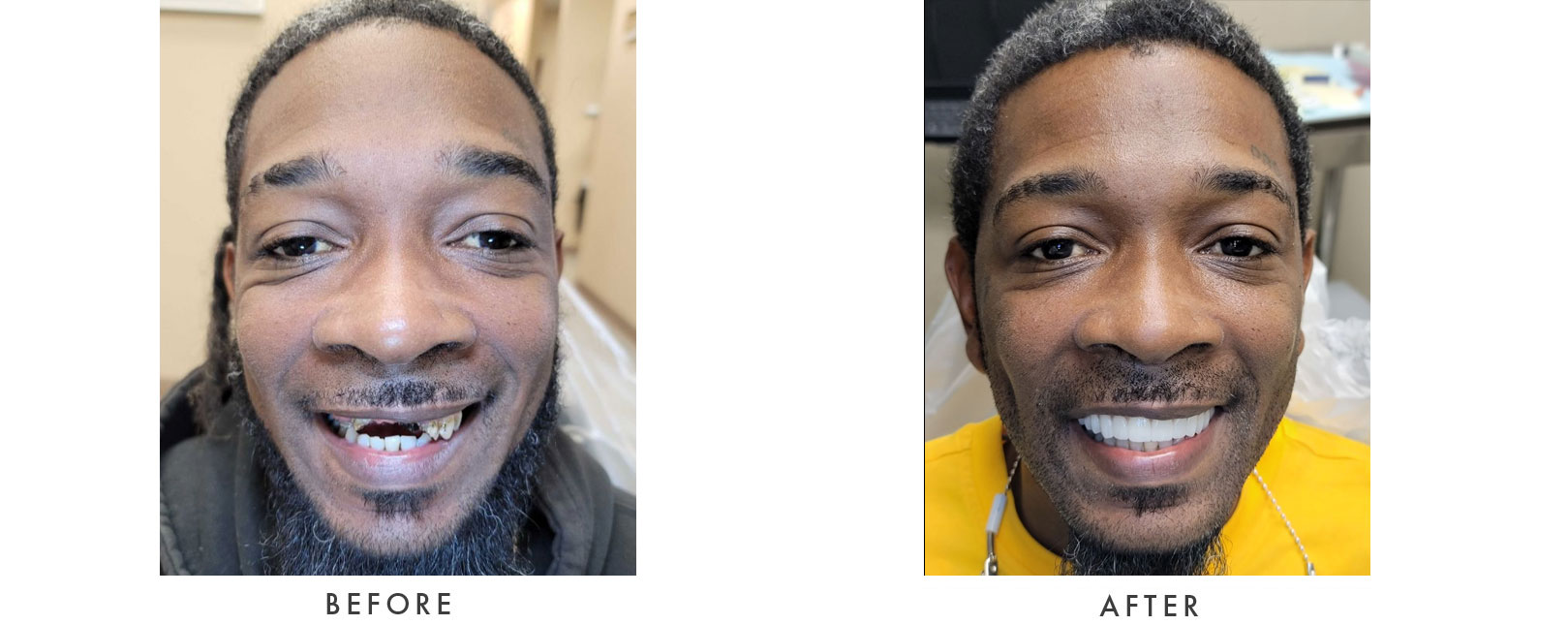 Dental Implants Patient Before and After