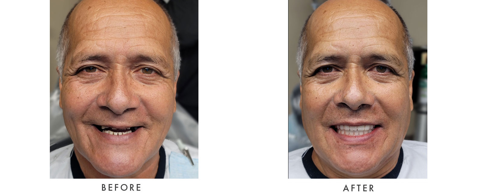 Dental Implants Patient Before and After