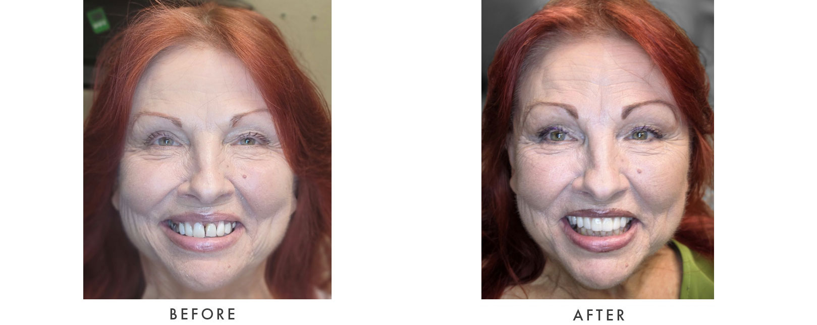 Dental Implants Patient Before and After