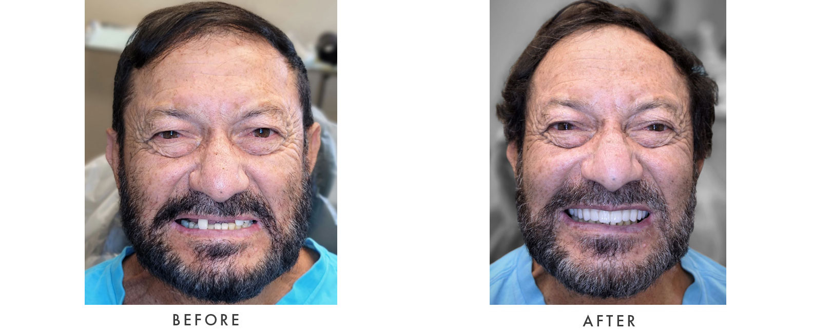 Dental Implants Patient Before and After