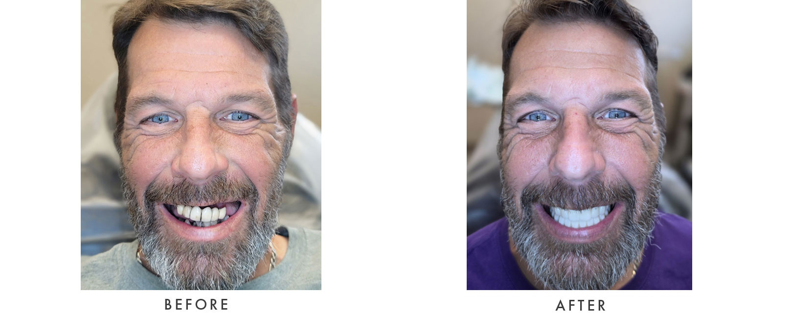 Dental Implants Patient Before and After
