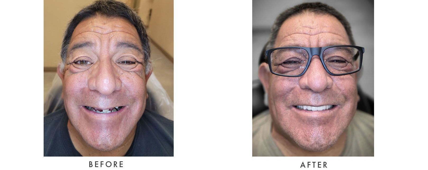 Dental Implants Patient Before and After