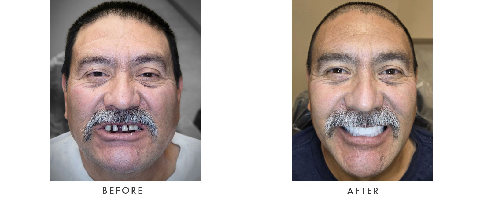 Dental Implants Patient Before and After